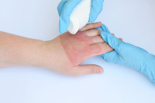 Compensation for Scarring and Disfigurement in Burn Injury Lawsuits in San Elizario